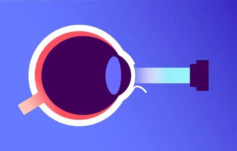 Lasik eye surgery Stock Illustration