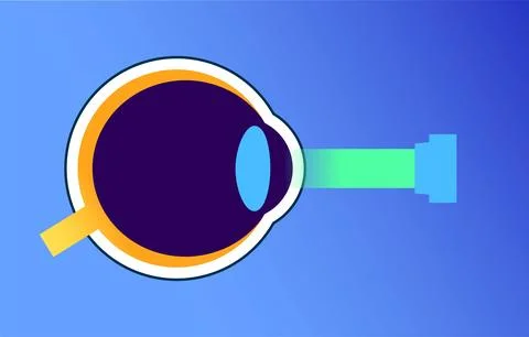 Lasik eye surgery 库存插图