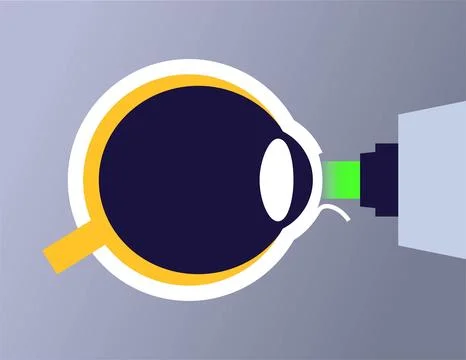 Lasik eye surgery Illustrazione stock