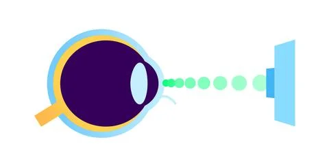 Lasik eye surgery 库存插图