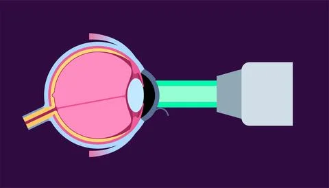 Lasik eye surgery Illustrazione stock