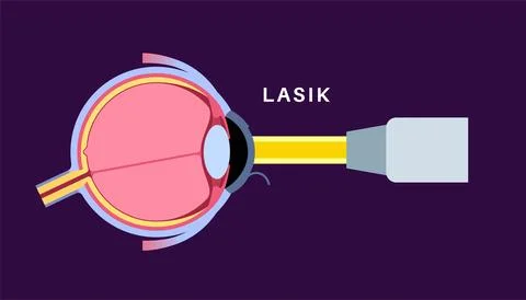 Lasik eye surgery Stock Illustration