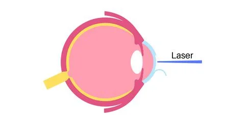 Lasik eye surgery 库存插图