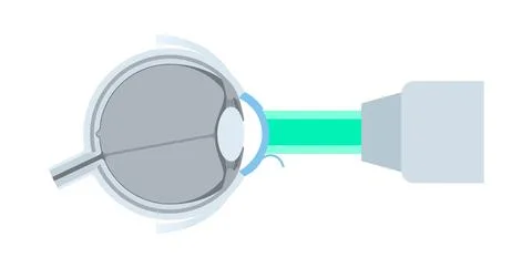 Lasik eye surgery Stock Illustration
