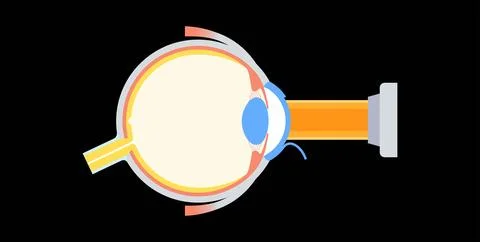 Lasik eye surgery 库存插图