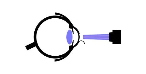Lasik eye surgery Illustrazione stock