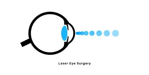 Lasik eye surgery 库存插图