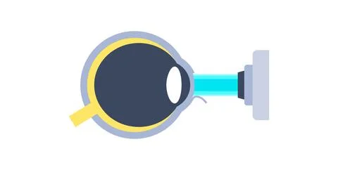 Lasik eye surgery Stock Illustration