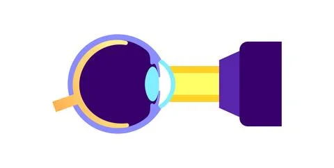 Lasik eye surgery Illustrazione stock
