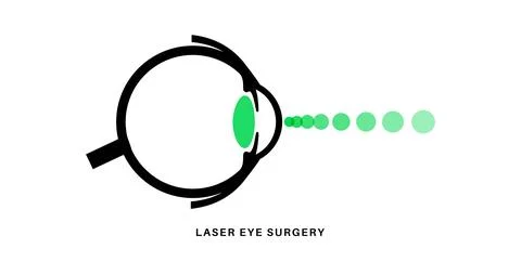 Lasik eye surgery Illustrazione stock