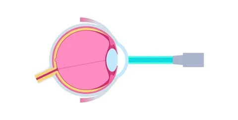 Lasik eye surgery Stock Illustration