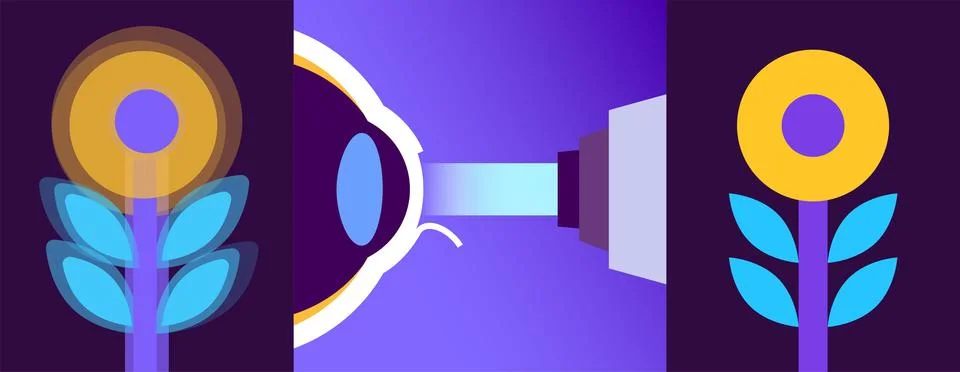 Lasik eye surgery イラスト素材