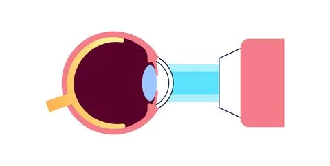 Lasik eye surgery 库存插图
