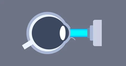 Lasik eye surgery 库存插图