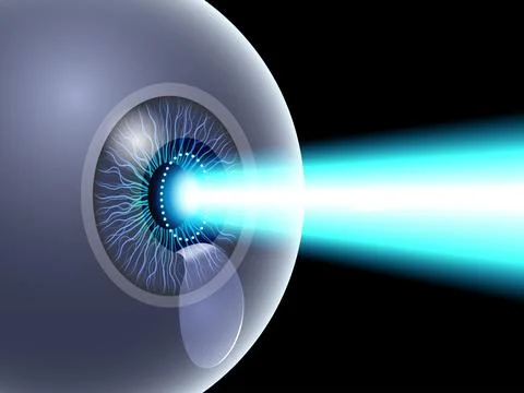 LASIK eye surgery Stock Illustration
