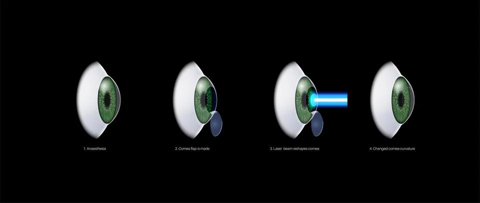 LASIK eye surgery Illustrazione stock