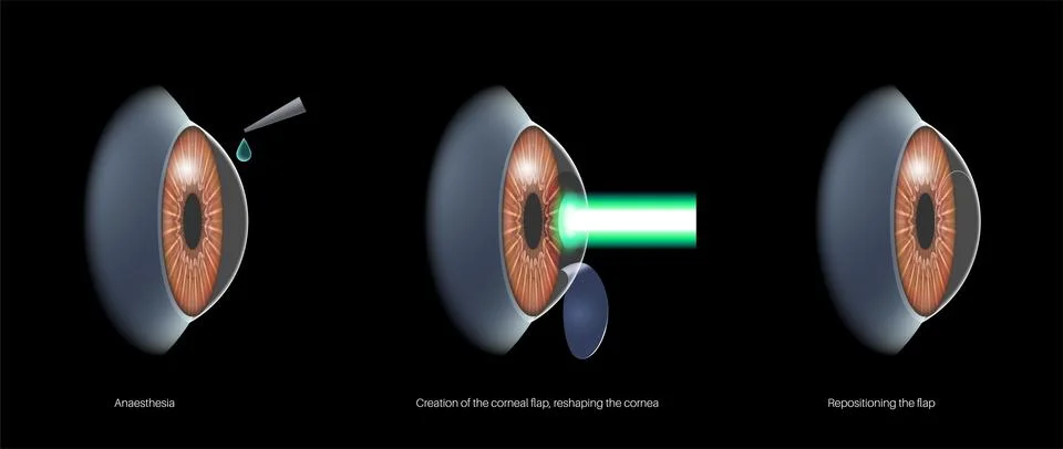 LASIK eye surgery 库存插图