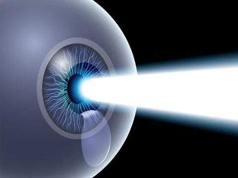 LASIK eye surgery Stockillustratie