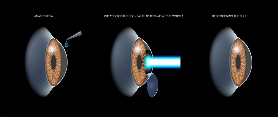 LASIK eye surgery 库存插图