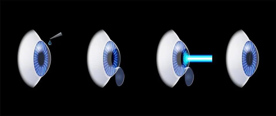 LASIK eye surgery Illustrazione stock