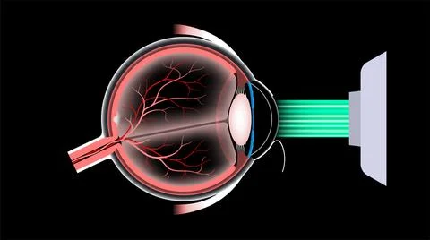 LASIK eye surgery イラスト素材