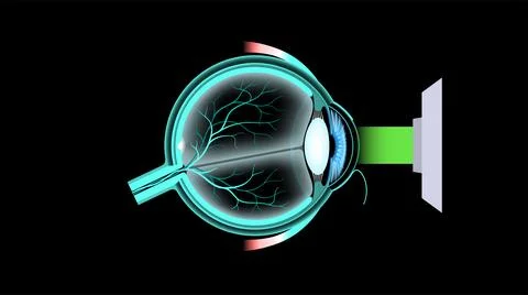 LASIK eye surgery 库存插图