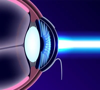 LASIK eye surgery Stock Illustration