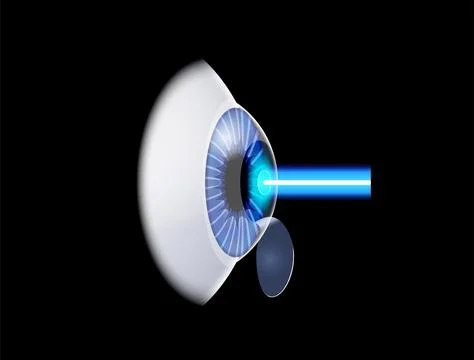 LASIK eye surgery Illustrazione stock