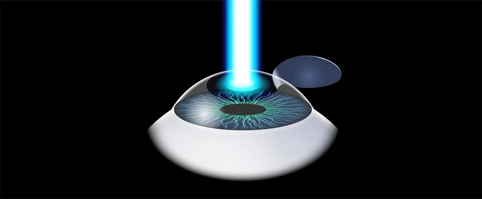 LASIK eye surgery Illustrazione stock