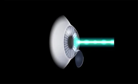 LASIK eye surgery Illustrazione stock