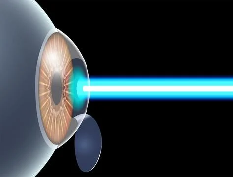 LASIK eye surgery Stockillustratie