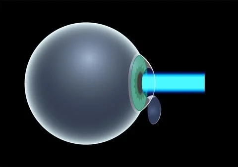 LASIK eye surgery Illustrazione stock