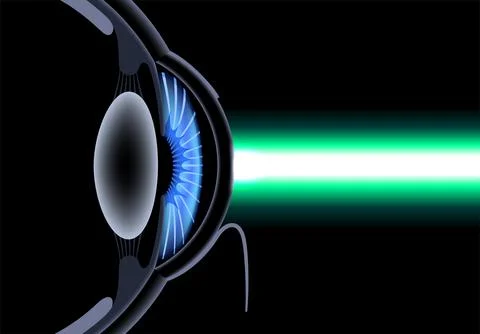 LASIK eye surgery イラスト素材