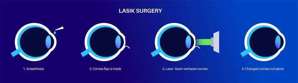 LASIK eye surgery Illustrazione stock