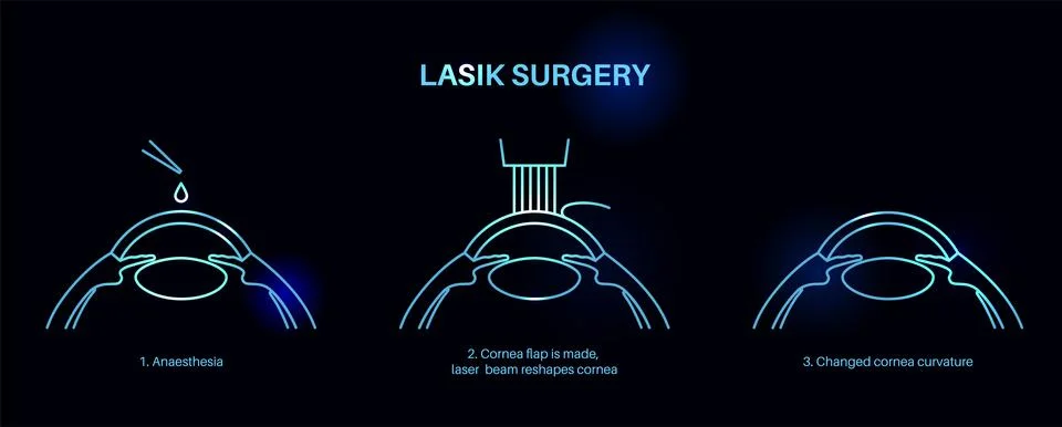 LASIK eye surgery Stockillustratie