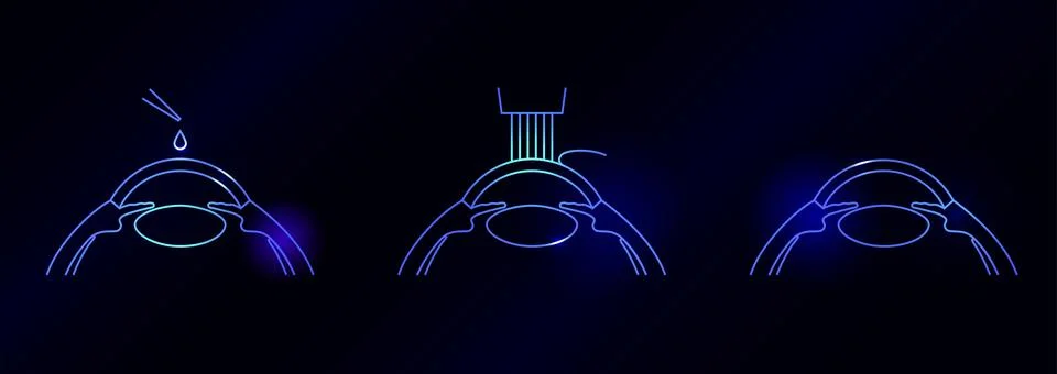 LASIK eye surgery Illustrazione stock