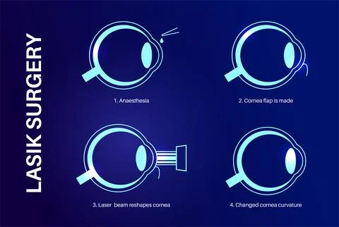 LASIK eye surgery Stock Illustration
