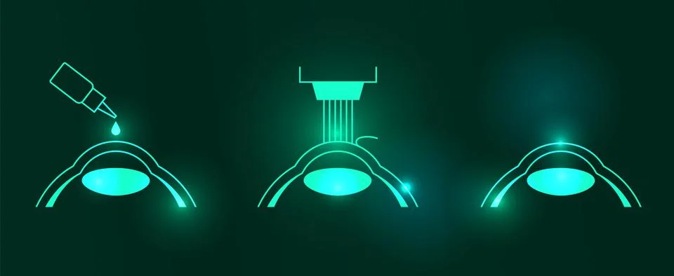 LASIK eye surgery Illustrazione stock
