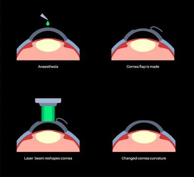 LASIK eye surgery Stock Illustration