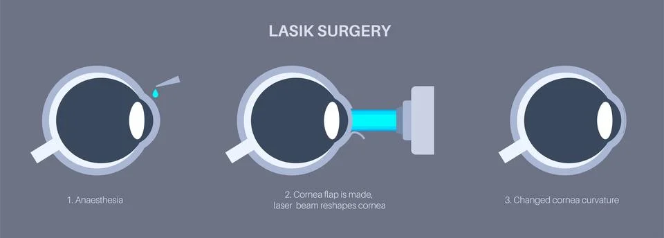 LASIK eye surgery Illustrazione stock