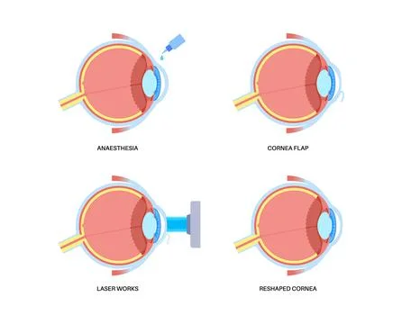 LASIK eye surgery Illustrazione stock