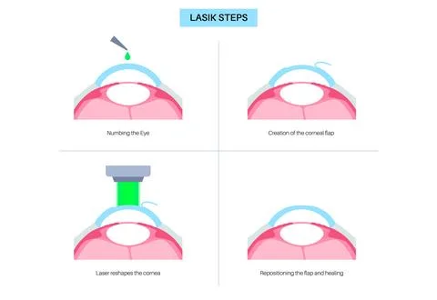 LASIK eye surgery Illustrazione stock