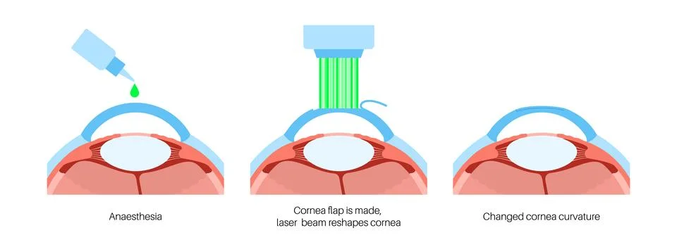 LASIK eye surgery Illustrazione stock