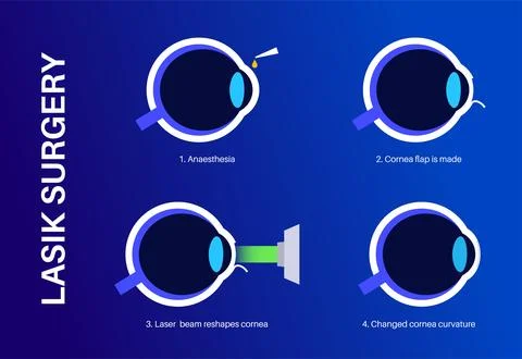 LASIK eye surgery Illustrazione stock