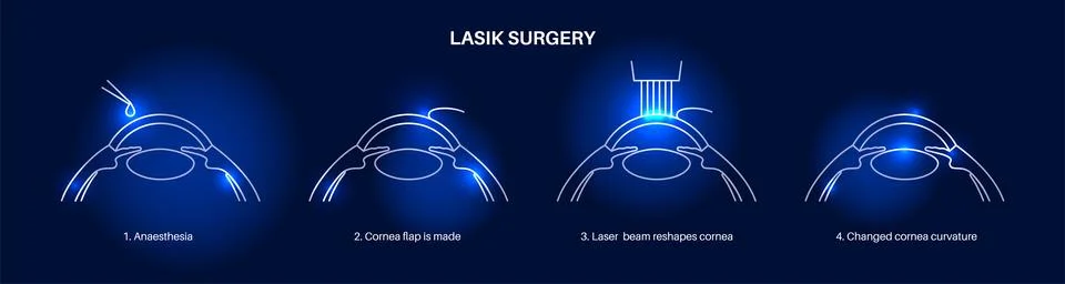 LASIK eye surgery Illustrazione stock