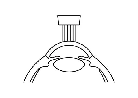 LASIK eye surgery Stock Illustration