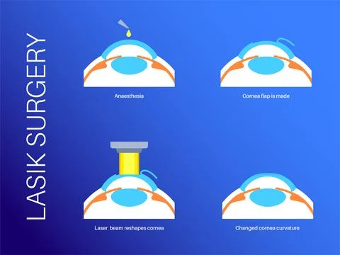 LASIK eye surgery Stock Illustration