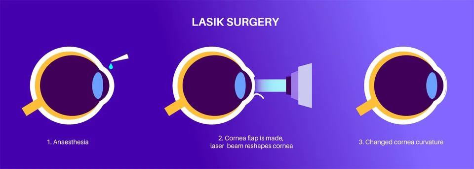 LASIK eye surgery Stockillustratie