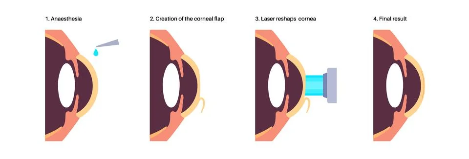 LASIK eye surgery Illustrazione stock