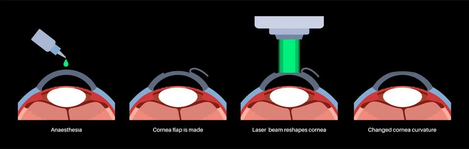 LASIK eye surgery Illustrazione stock